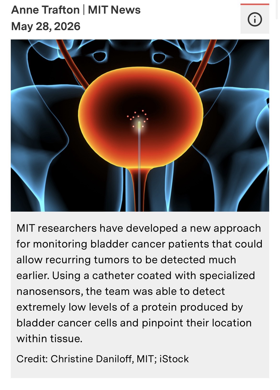 A new sensor could enable earlier detection of bladder cancer